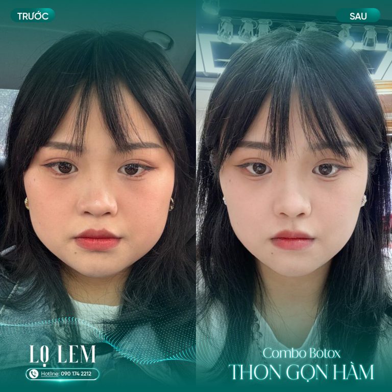 Tiêm Filler má - cằm