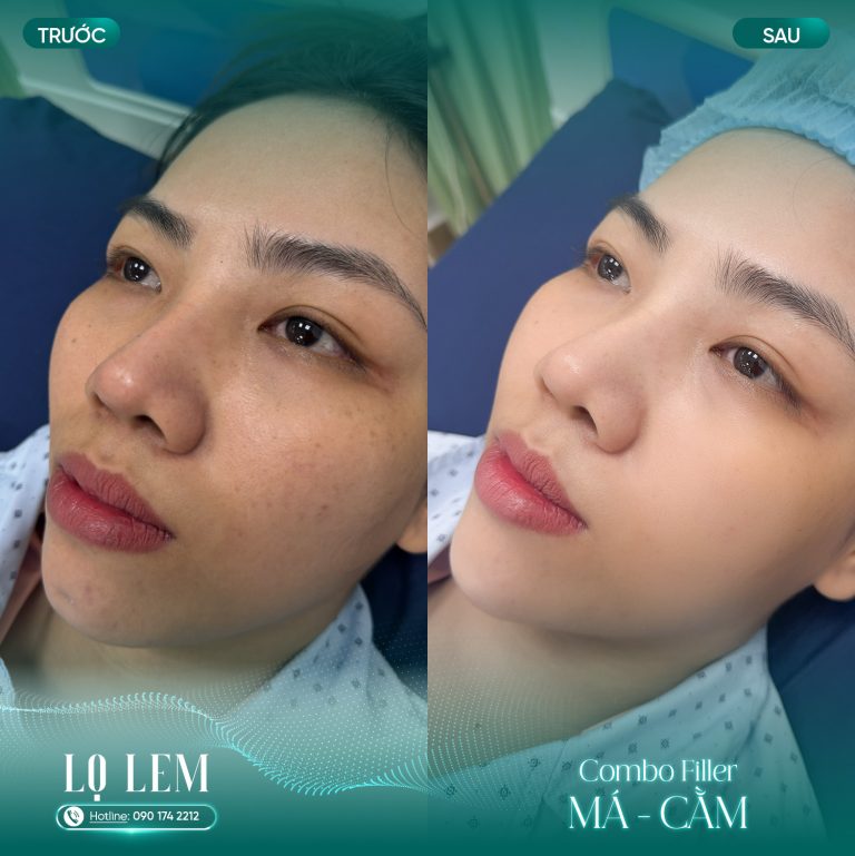 Tiêm botox thon gọn hàm
