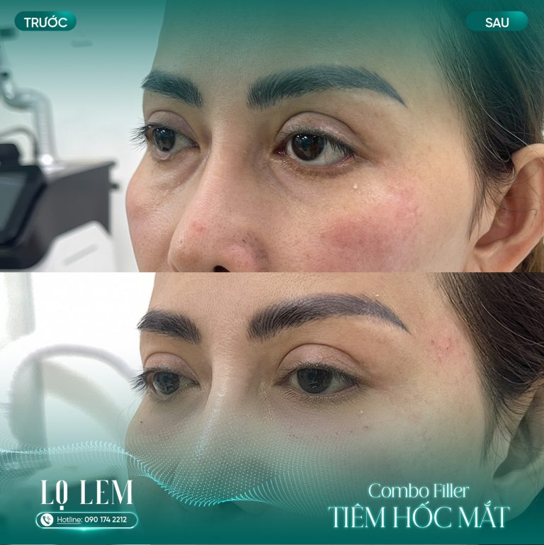 Tiêm thon gọn bắp chân